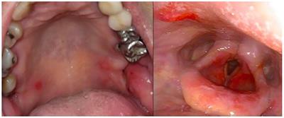 Activity of apremilast in a patient with severe pemphigus vulgaris: case report